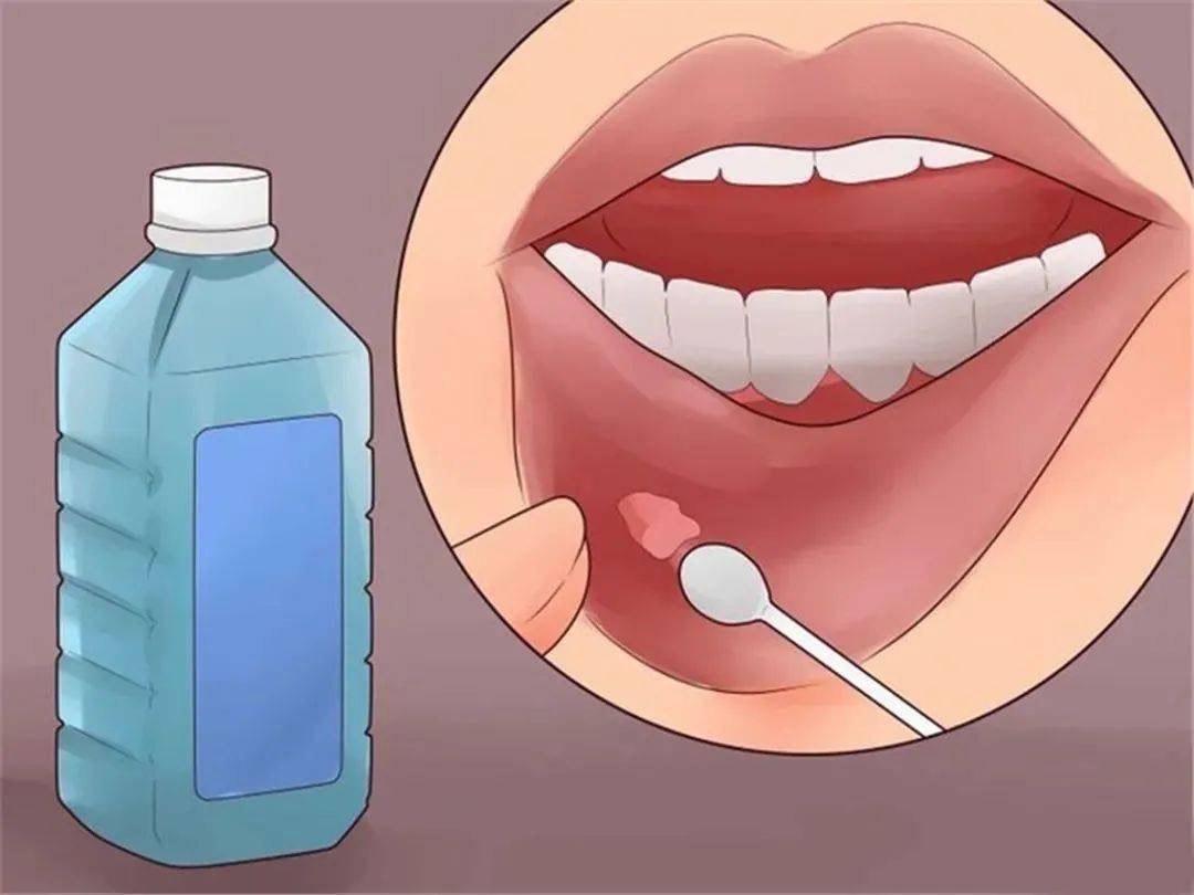 Miraculous Mouth Ulcers Demystified: Pain Says Goodbye, Worr