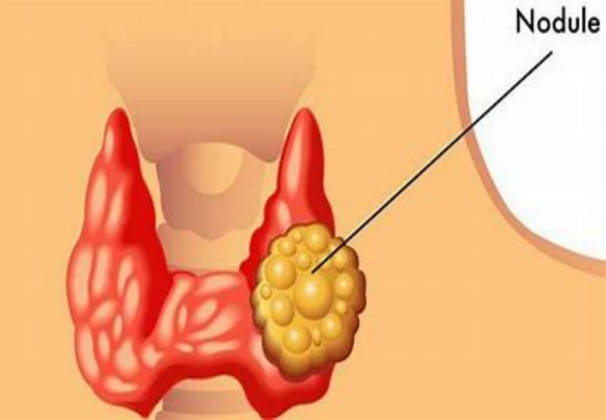 Thyroid Cancer: Unnecessary Surgery Dilemma