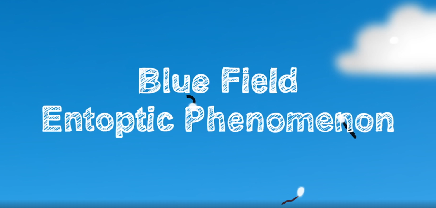Uninvited Guests in Our Vision: Decoding Eye Floaters and Blue Sky Sprites