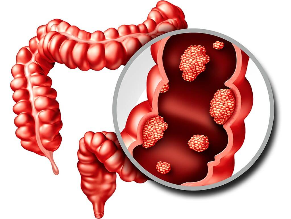 Symptoms of Bowel Cancer. Booking Health