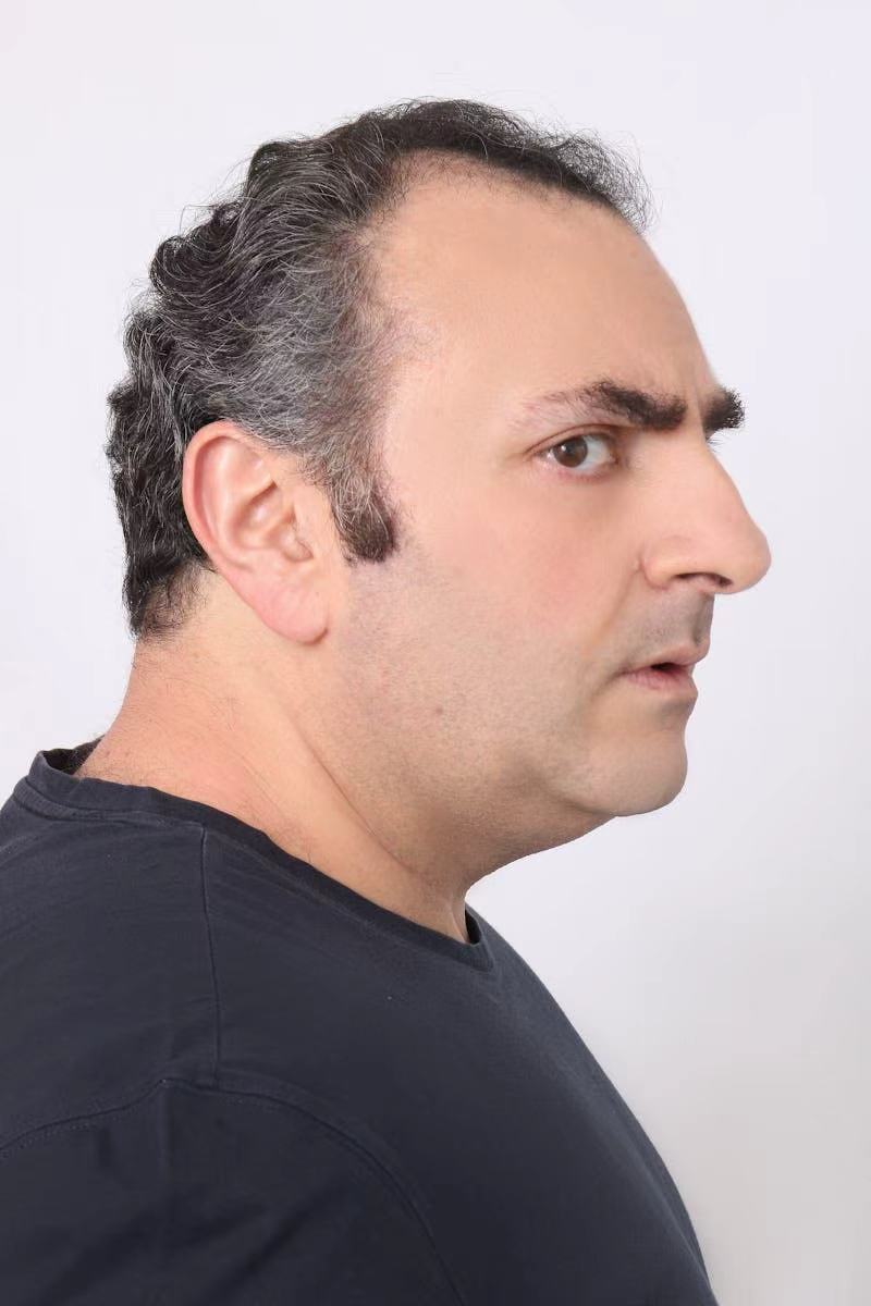 The Secret Behind the Hairline: The Invisible Barometer of Mental Health